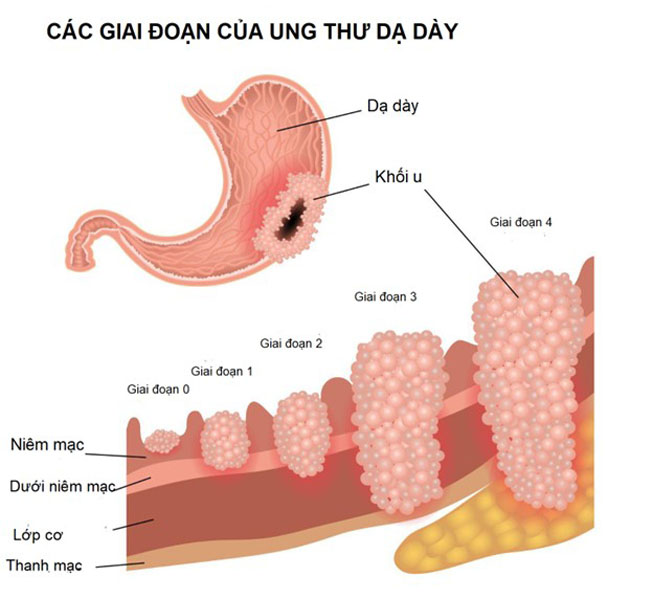 ung-thu-da-day-co-may-giai-doan