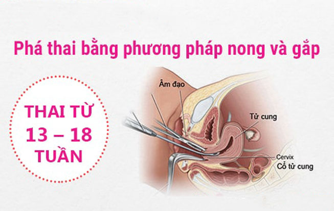 pha-thai-bang-phuong-phap-nong-va-gap