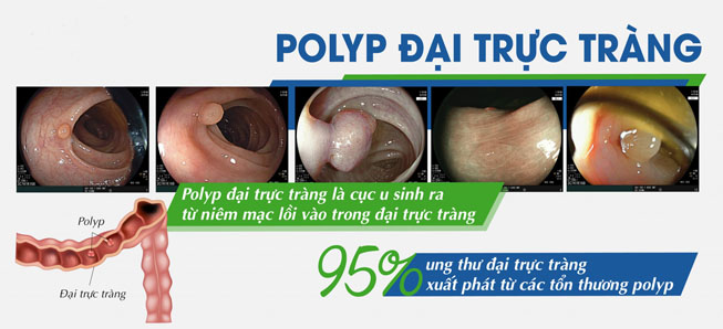 polyp-dai-trang-co-dan-den-ung-thu-khong